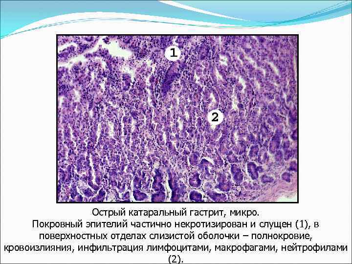 Острый катаральный гастрит, микро. Покровный эпителий частично некротизирован и слущен (1), в поверхностных отделах