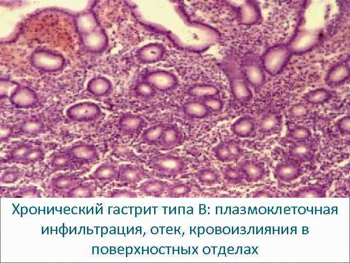 Хронический гастрит типа B: плазмоклеточная инфильтрация, отек, кровоизлияния в поверхностных отделах 