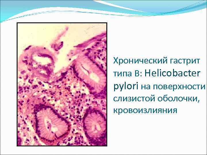 Хронический гастрит типа B: Нelicobacter pylori на поверхности слизистой оболочки, кровоизлияния 