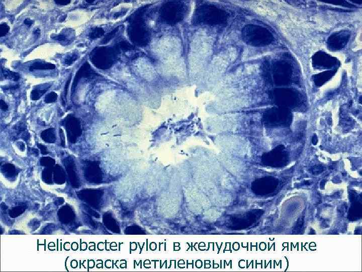 Нelicobacter pylori в желудочной ямке (окраска метиленовым синим) 