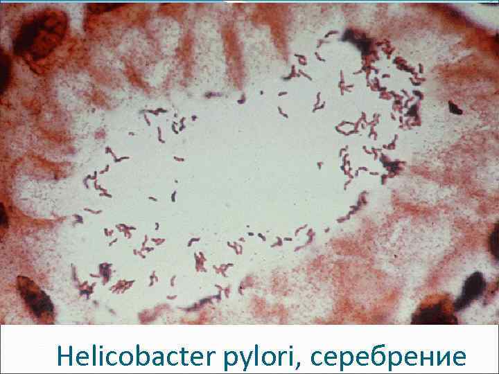 Нelicobacter pylori, серебрение 