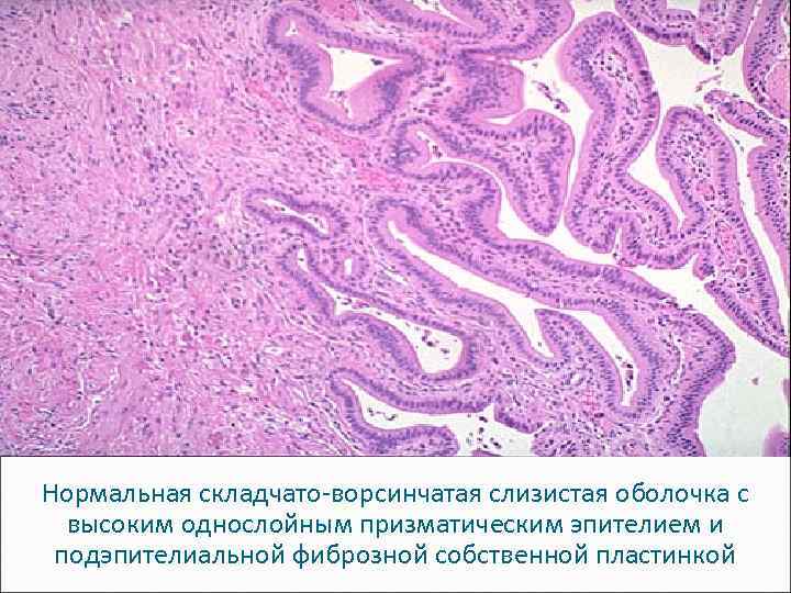 Нормальная складчато-ворсинчатая слизистая оболочка с высоким однослойным призматическим эпителием и подэпителиальной фиброзной собственной пластинкой