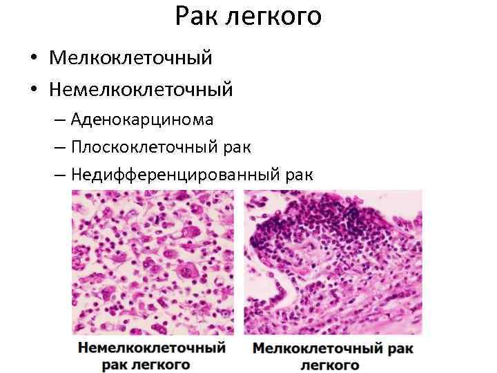 Рак легкого • Мелкоклеточный • Немелкоклеточный – Аденокарцинома – Плоскоклеточный рак – Недифференцированный рак