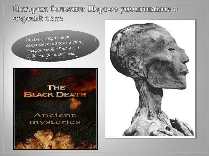 История болезни: Первое упоминание о черной оспе ния Оспенные пораже же мумии, сохранились на