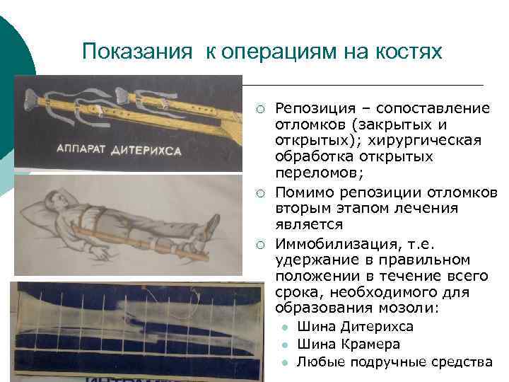 Переломы костей операции