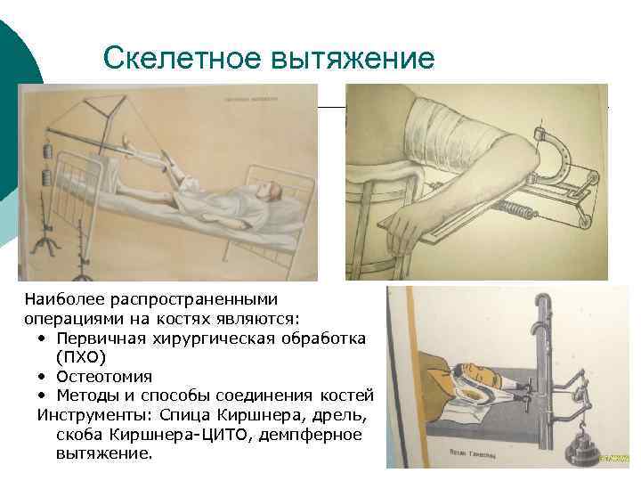 Скелетное вытяжение Наиболее распространенными операциями на костях являются: • Первичная хирургическая обработка (ПХО) •