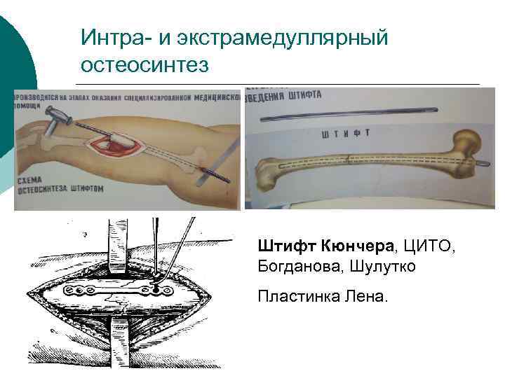 Интра- и экстрамедуллярный остеосинтез Штифт Кюнчера, ЦИТО, Богданова, Шулутко Пластинка Лена. 