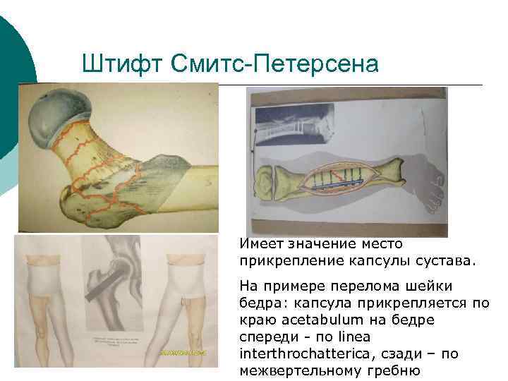 Штифт Смитс-Петерсена Имеет значение место прикрепление капсулы сустава. На примере перелома шейки бедра: капсула