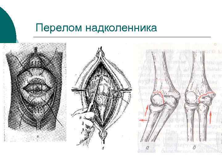 Перелом надколенника 