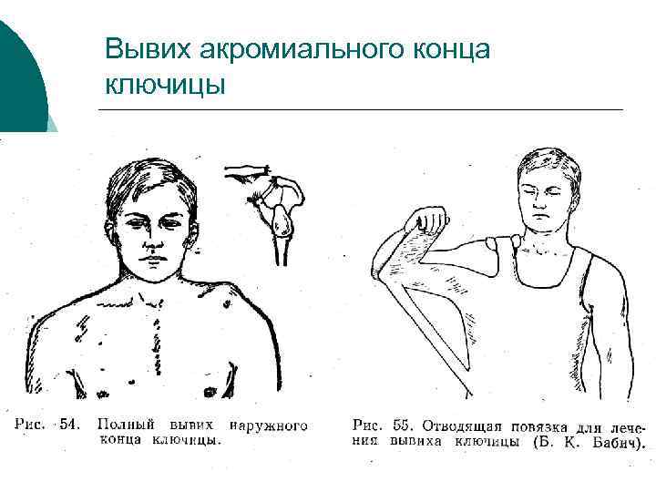 Вывих акромиального конца ключицы 