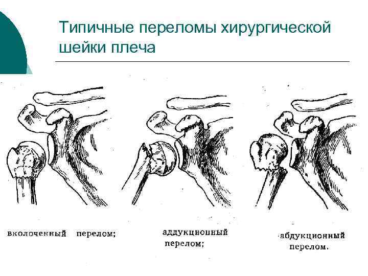 Типичные переломы хирургической шейки плеча 