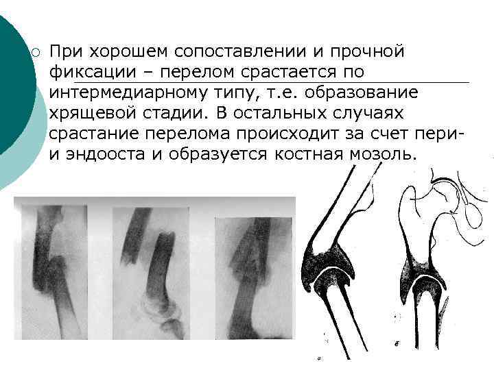 ¡ При хорошем сопоставлении и прочной фиксации – перелом срастается по интермедиарному типу, т.