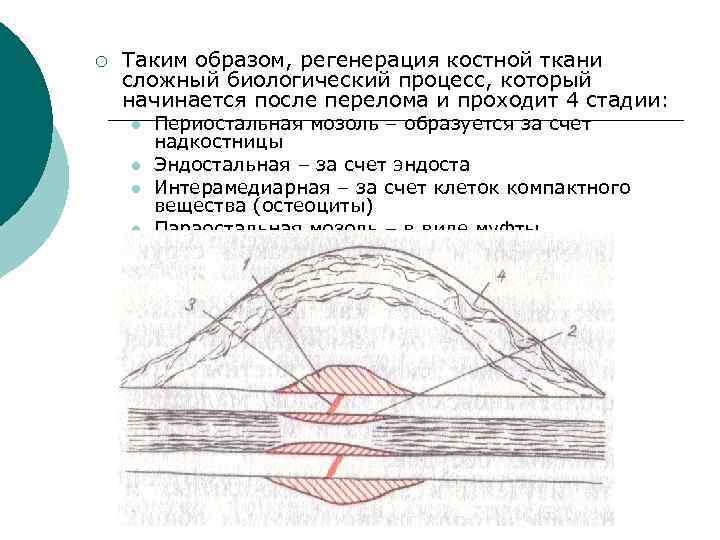 Первичная костная мозоль