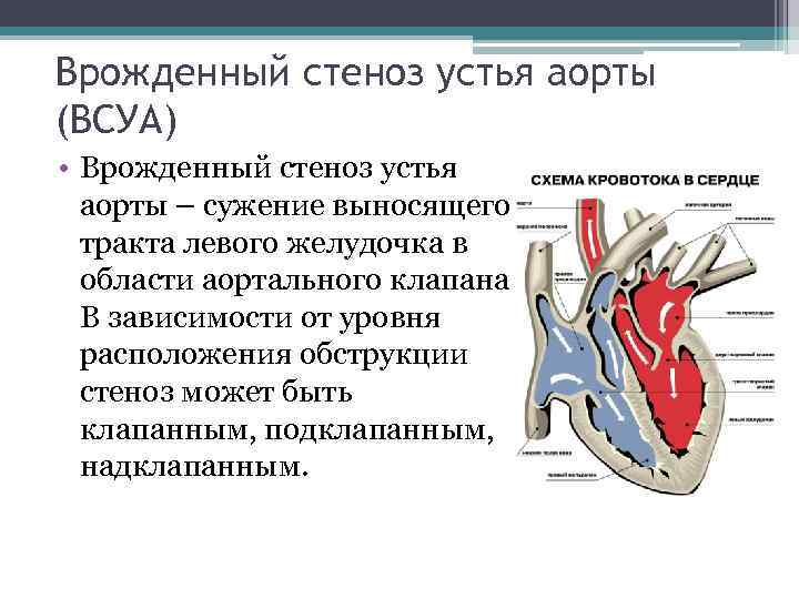 Стеноз аорты у детей презентация