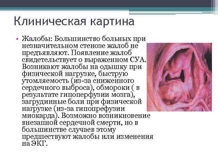 Клиническая картина • Жалобы: Большинство больных при незначительном стенозе жалоб не предъявляют. Появление жалоб