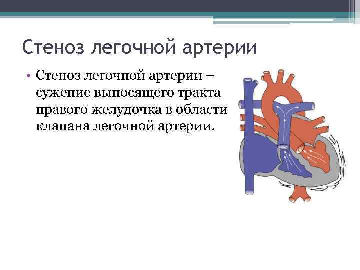 Стеноз легочной артерии • Стеноз легочной артерии – сужение выносящего тракта правого желудочка в