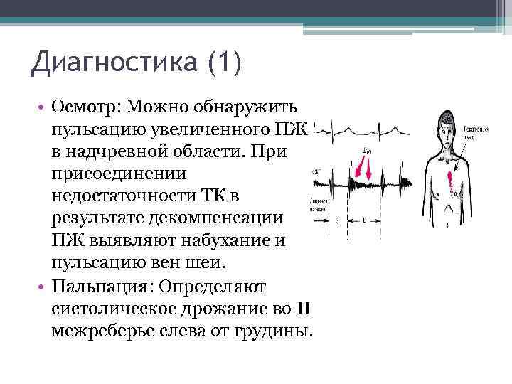 Диагностика (1) • Осмотр: Можно обнаружить пульсацию увеличенного ПЖ в надчревной области. При присоединении