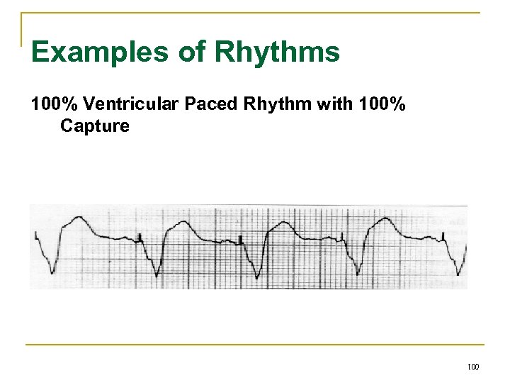 Examples of Rhythms 100% Ventricular Paced Rhythm with 100% Capture 100 