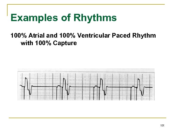 Examples of Rhythms 100% Atrial and 100% Ventricular Paced Rhythm with 100% Capture 101
