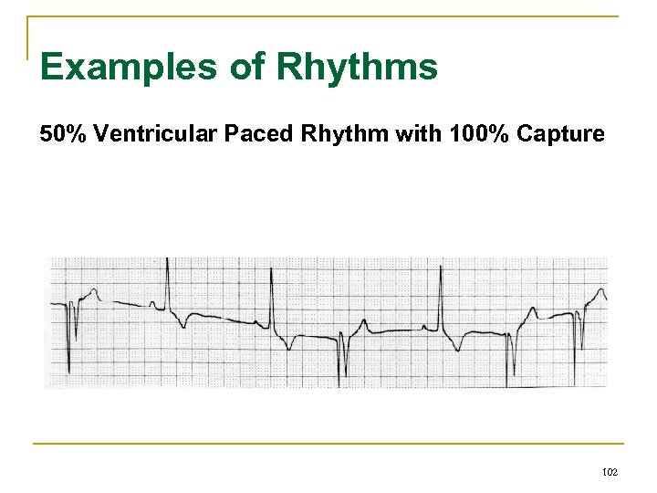 Examples of Rhythms 50% Ventricular Paced Rhythm with 100% Capture 102 