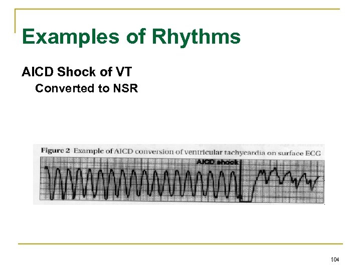 Examples of Rhythms AICD Shock of VT Converted to NSR 104 
