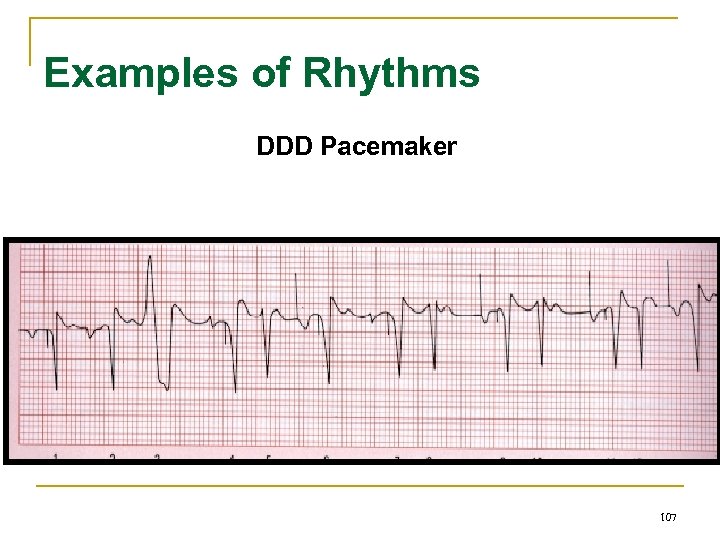 Examples of Rhythms DDD Pacemaker 107 