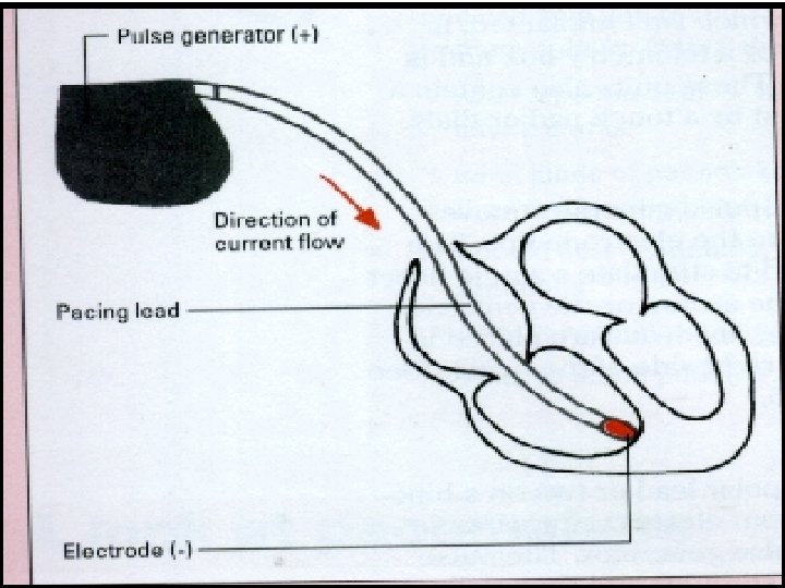 Unipolar Pacemaker 22 