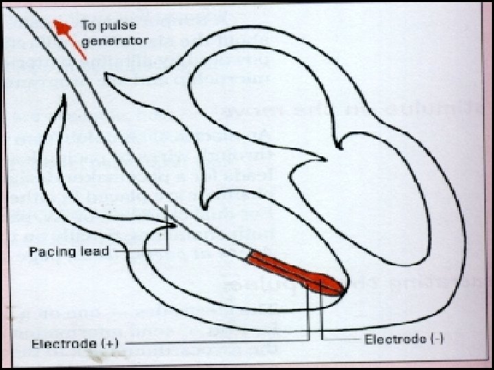 Bipolar Pacemaker 24 