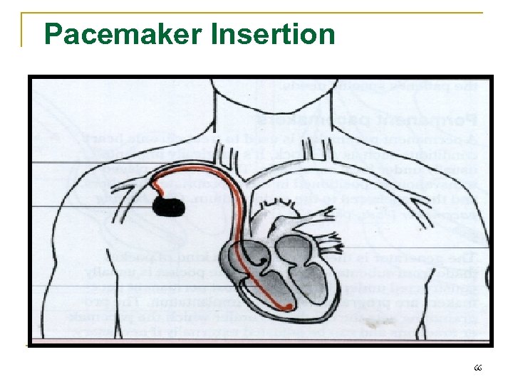 Pacemaker Insertion 66 
