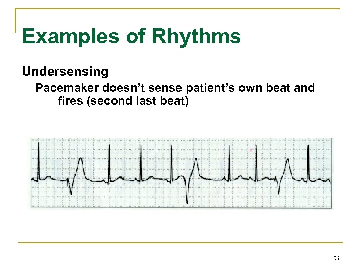 Examples of Rhythms Undersensing Pacemaker doesn’t sense patient’s own beat and fires (second last