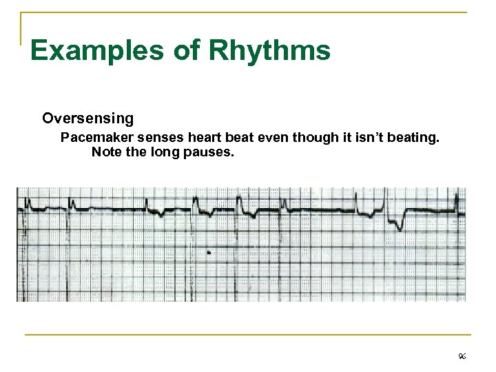 Examples of Rhythms Oversensing Pacemaker senses heart beat even though it isn’t beating. Note