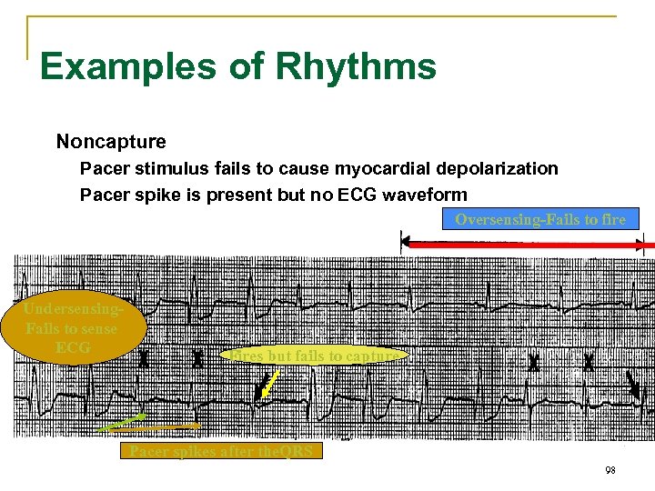 Examples of Rhythms Noncapture Pacer stimulus fails to cause myocardial depolarization Pacer spike is
