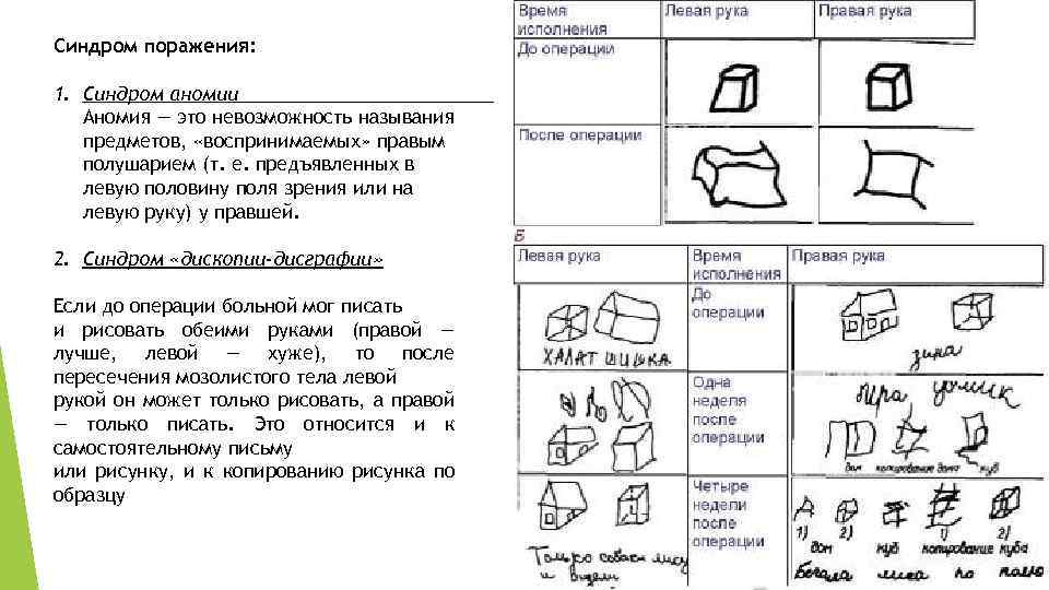 Синдром поражения: 1. Синдром аномии Аномия — это невозможность называния предметов, «воспринимаемых» правым полушарием