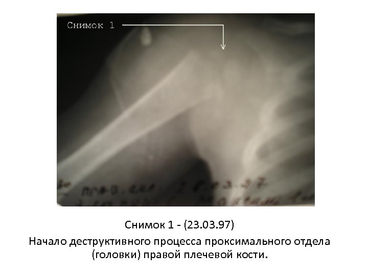 Снимок 1 - (23. 03. 97) Начало деструктивного процесса проксимального отдела (головки) правой плечевой