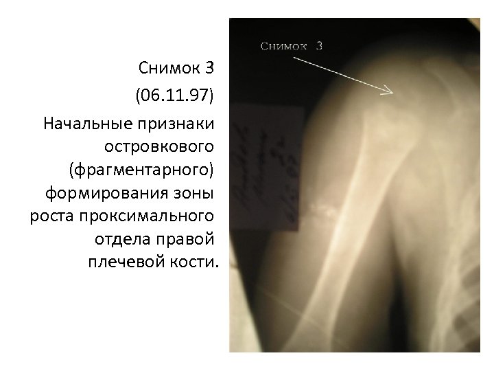Снимок 3 (06. 11. 97) Начальные признаки островкового (фрагментарного) формирования зоны роста проксимального отдела