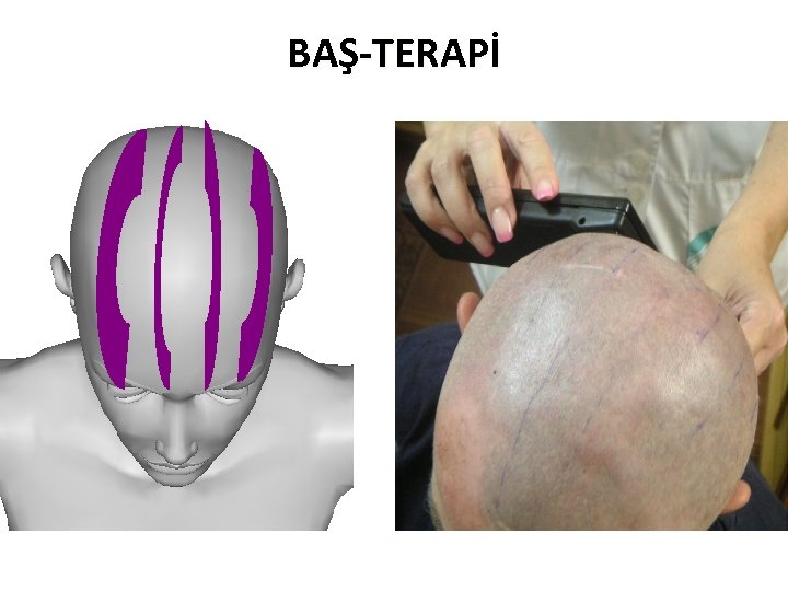 BAŞ-TERAPİ 