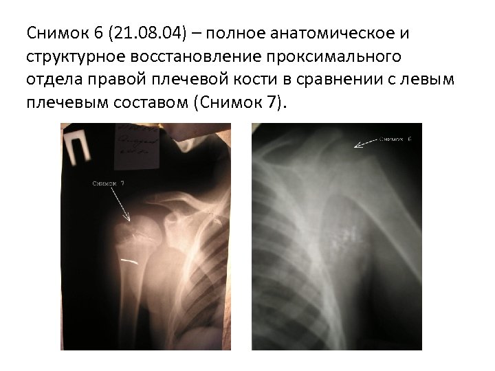 Снимок 6 (21. 08. 04) – полное анатомическое и структурное восстановление проксимального отдела правой