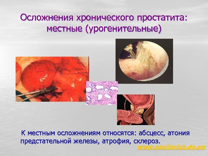 Осложнения хронического простатита: местные (урогенительные) К местным осложнениям относятся: абсцесс, атония предстательной железы, атрофия,