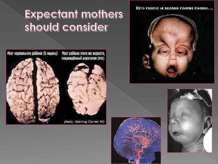 Expectant mothers should consider 