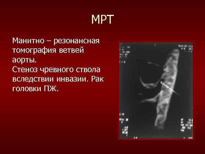 МРТ Манитно – резонансная томография ветвей аорты. Стеноз чревного ствола вследствии инвазии. Рак головки