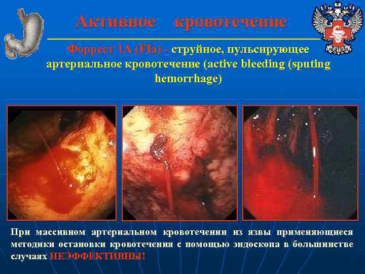 Активное кровотечение Форрест 1 А (FIa) - струйное, пульсирующее артериальное кровотечение (active bleeding (sputing