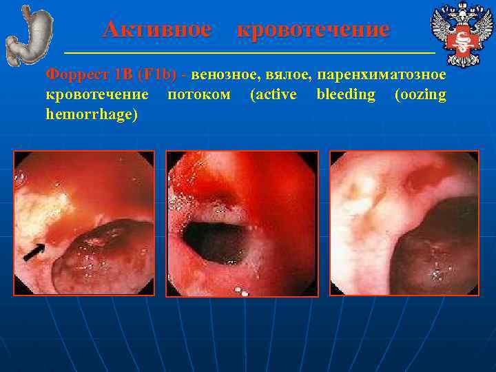 Активное кровотечение Форрест 1 В (F 1 b) - венозное, вялое, паренхиматозное кровотечение потоком