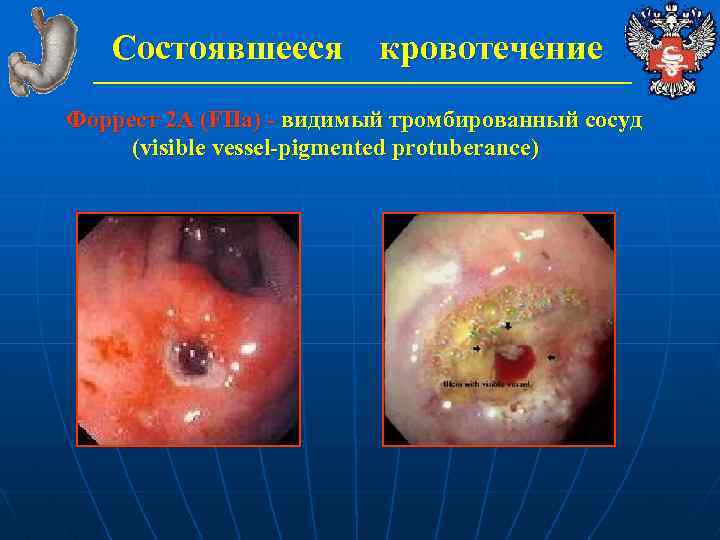 Состоявшееся кровотечение Форрест 2 А (FIIa) - видимый тромбированный сосуд (visible vessel-pigmented protuberance) 