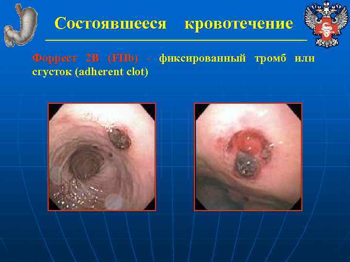 Состоявшееся кровотечение Форрест 2 В (FIIb) - фиксированный тромб или сгусток (adherent clot) 