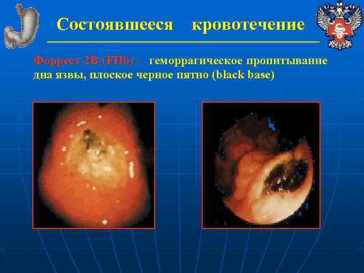 Состоявшееся кровотечение Форрест 2 В (FIIb) - геморрагическое пропитывание дна язвы, плоское черное пятно