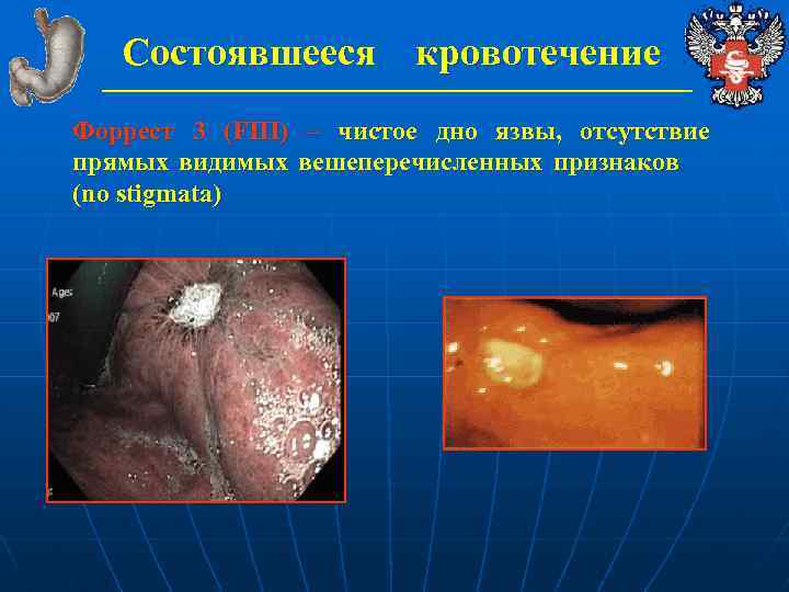 Состоявшееся кровотечение Форрест 3 (FIII) – чистое дно язвы, отсутствие прямых видимых вешеперечисленных признаков