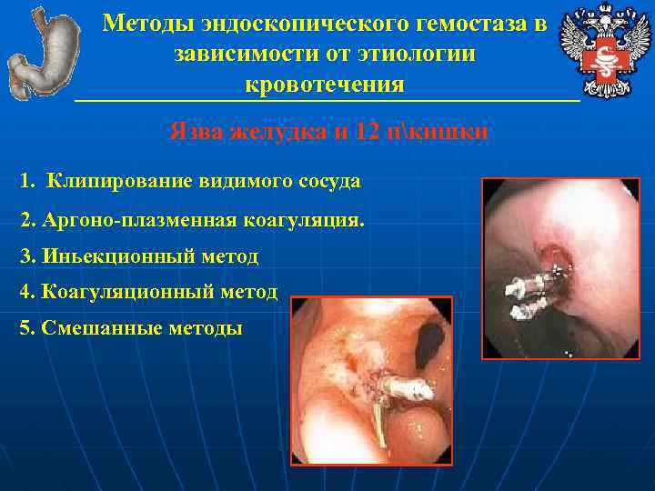 Методы эндоскопического гемостаза в зависимости от этиологии кровотечения Язва желудка и 12 пкишки 1.