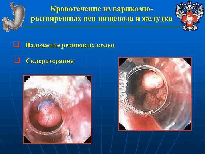 Кровотечение из варикознорасширенных вен пищевода и желудка q Наложение резиновых колец q Склеротерапия 