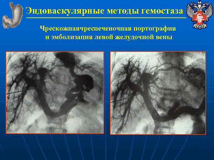 Эндоваскулярные методы гемостаза Чрескожнаячреспеченочная портография и эмболизация левой желудочной вены 