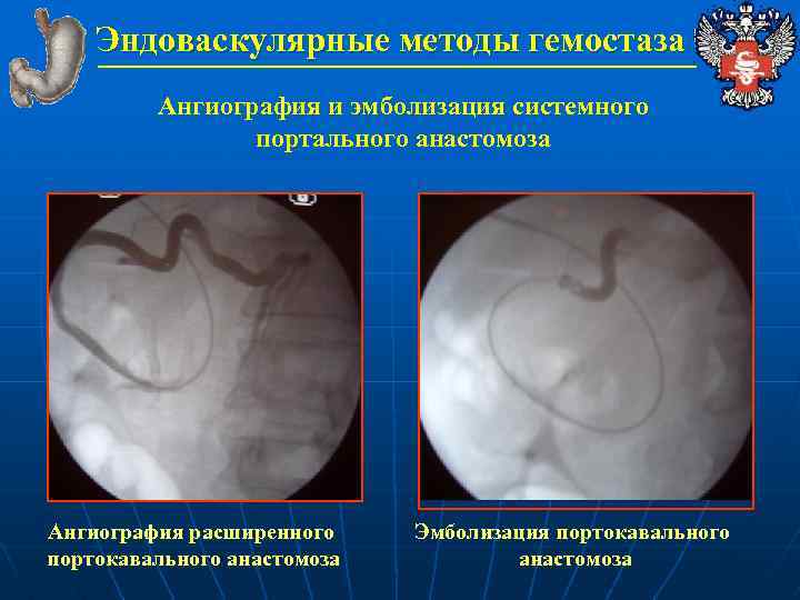 Эндоваскулярные методы гемостаза Ангиография и эмболизация системного портального анастомоза Ангиография расширенного портокавального анастомоза Эмболизация